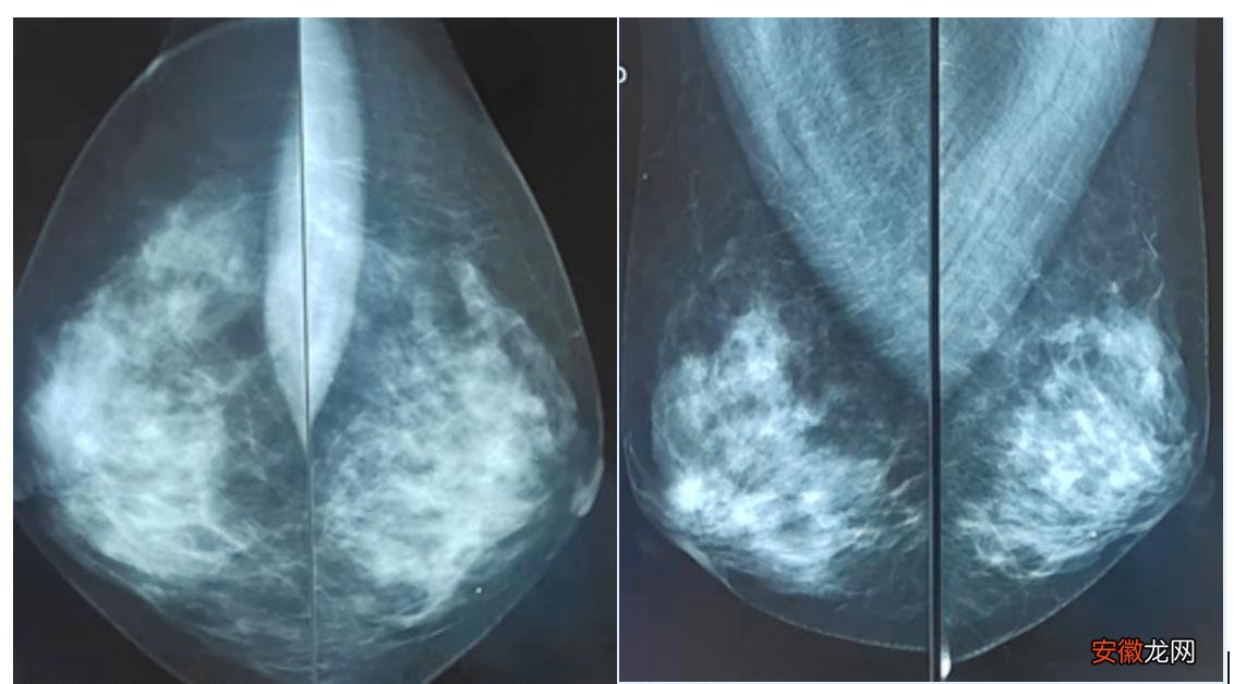 搜狐医药｜北京协和最新研究指南：B超是最适合中国人的乳腺癌筛查手段