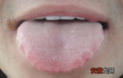 舌苔有齿痕是怎么回事