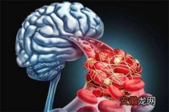 脑梗塞是什么病 脑梗塞是什么原因造成的