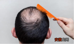 秃顶是现在中年人常犯的一种头发症状 治疗斑秃的几种方法