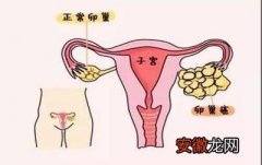 女人一旦有这三个特征就是卵巢癌候选人