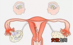 什么是多囊卵巢综合症如何预防多囊卵巢综合症